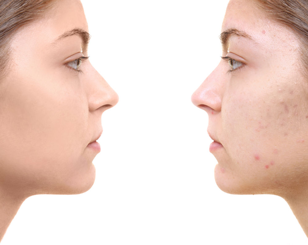 remove facial wrinkles